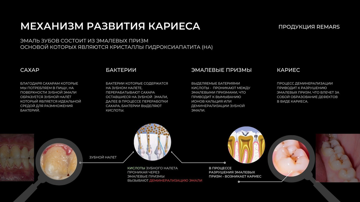 REMARS GEL двухкомпонентный комплекс для реминерализации эмали ...