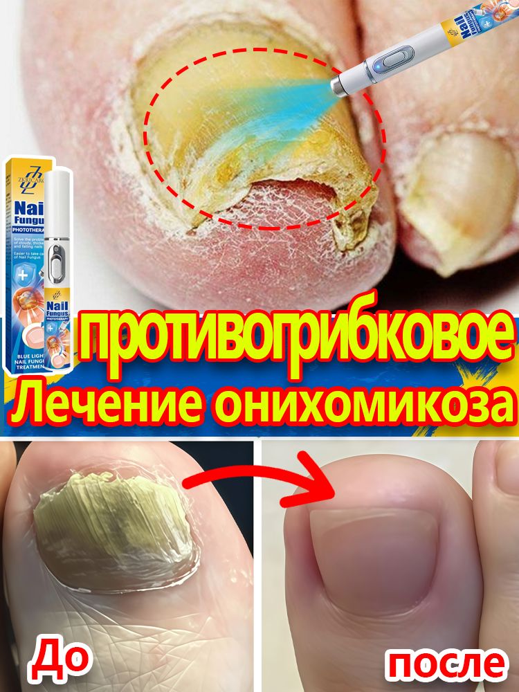 Лазернаяуказкадлялечениягрибканогтейнаногахируках,длялечениягрибкаионихолизиса,длястимуляцииростаиукрепленияногтей,дляуходазаногтямиикожей.
