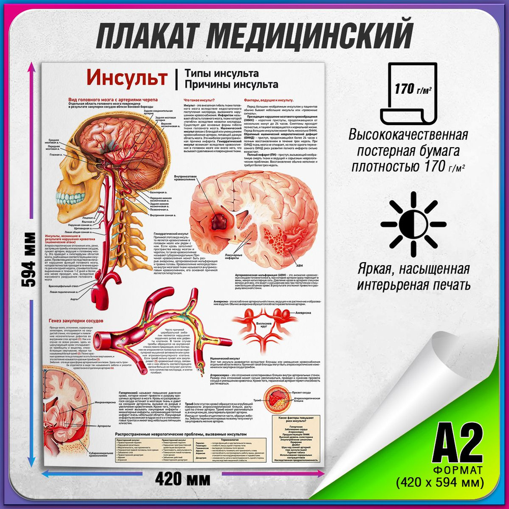 Информационный медицинский плакат "Инсульт. Типы и причины инсульта" / А-2 (60x42 см.)  #1