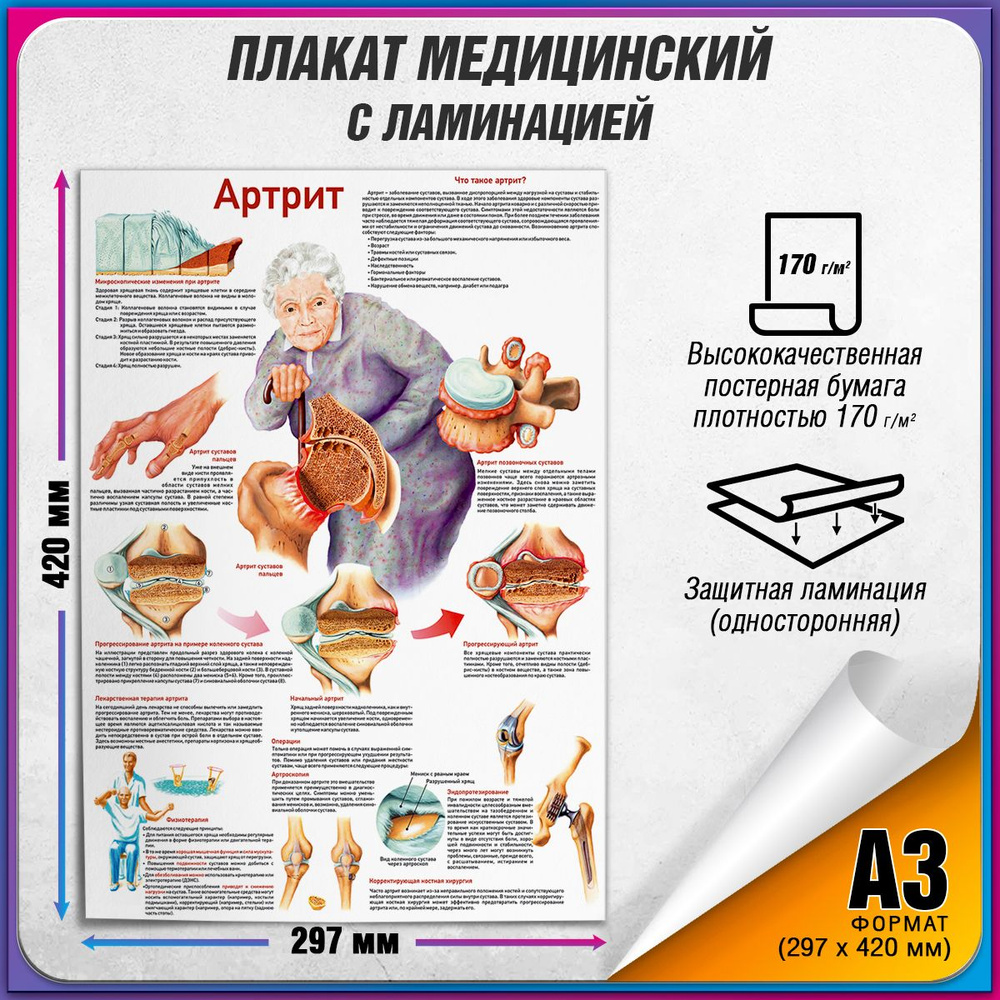 Информационный медицинский плакат "Артрит" / ламинированный / А-3 (30x42 см.)  #1