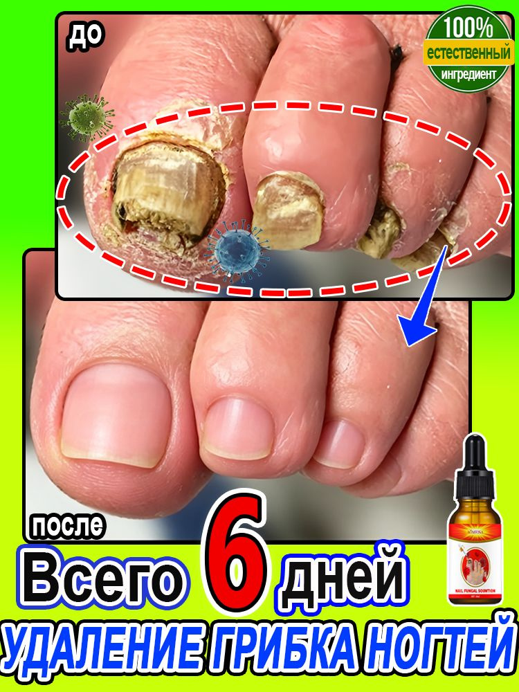 Противогрибковое масло для ухода за ногтями, используемое для ухода за ногтевым мхом, подавляет бактерии, #1