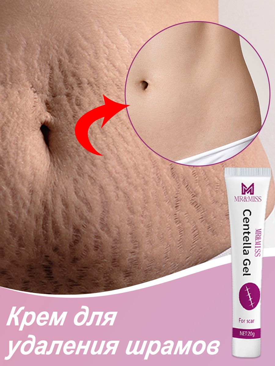 Почему кремы не помогают от растяжек и какие методы действительно эффективны