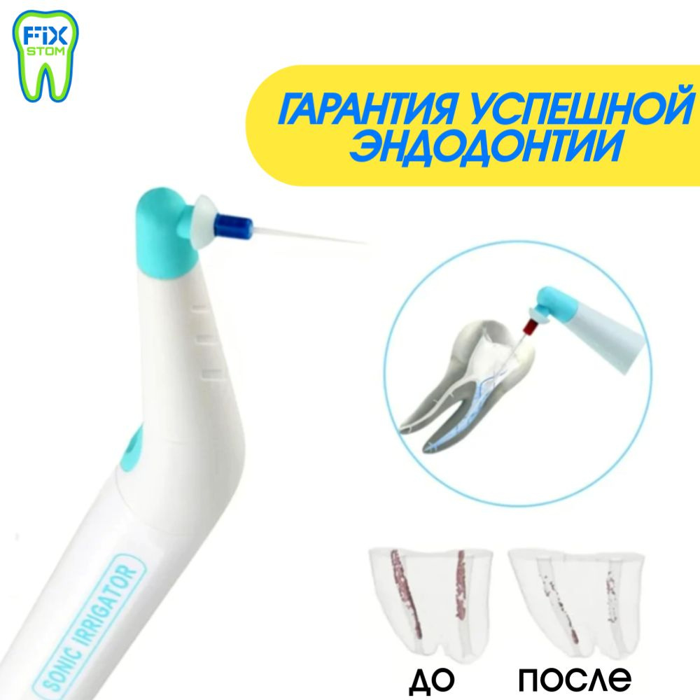 Эндоактиватор #1