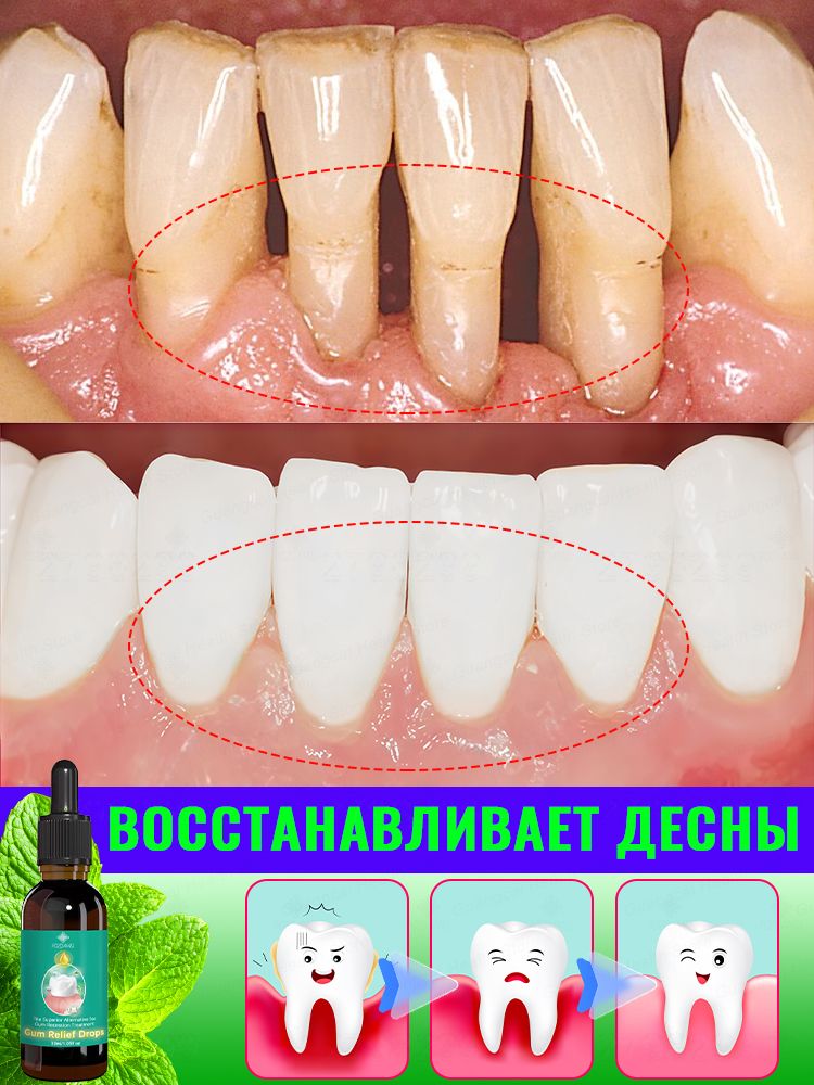 Маслодлягигиеныполостирта.Быстролечитопухшиеиотступающиедесны,пародонтит,снимаетчувствительностьдесениподдерживаетгигиенуполостирта.30мл