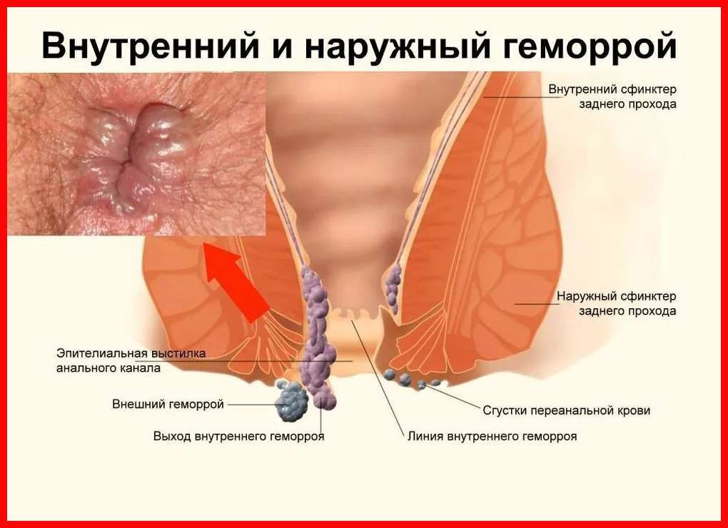 Анус После Первого Секса