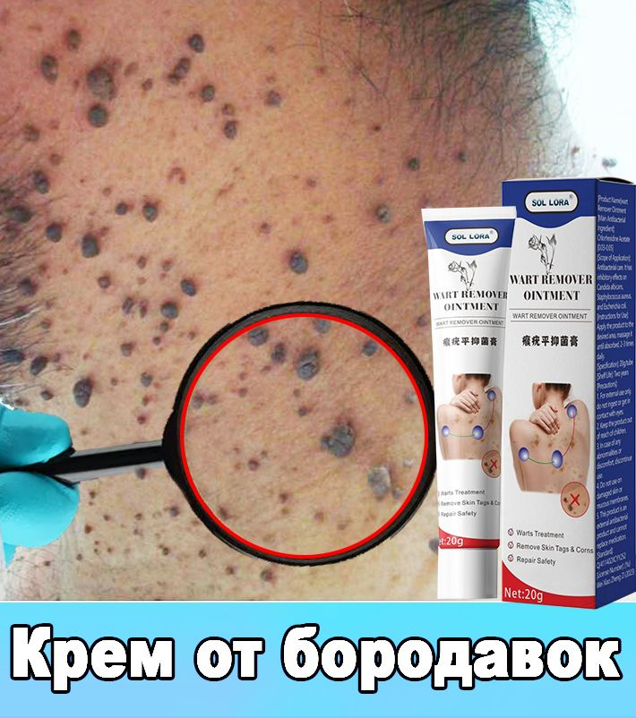 Профессиональный крем для удаления бородавок 20г, эффективен против вульгарных бородавок, папиллом и #1