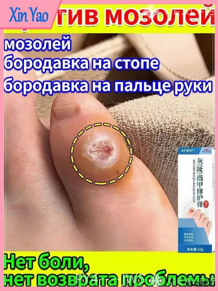 Эксклюзивный крем и лейкопластырь для устранения натоптышей, а также стержневых мозолей на пальцах и #1