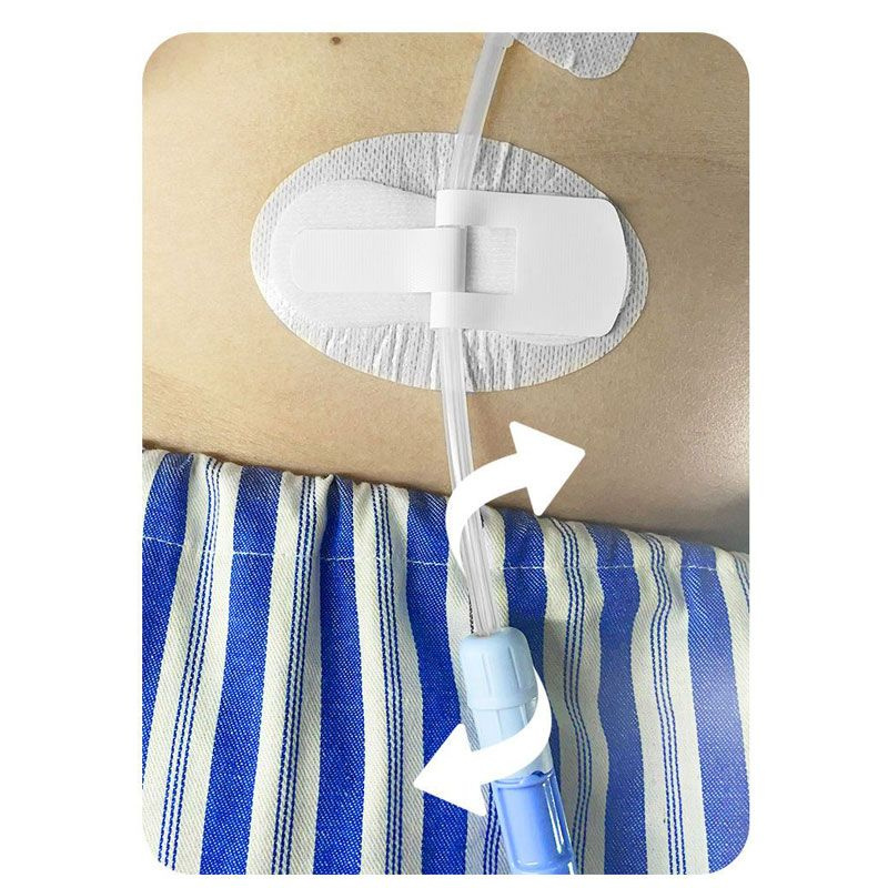 Заплатка для фиксации катетера перитонеального диализа медицинского ...