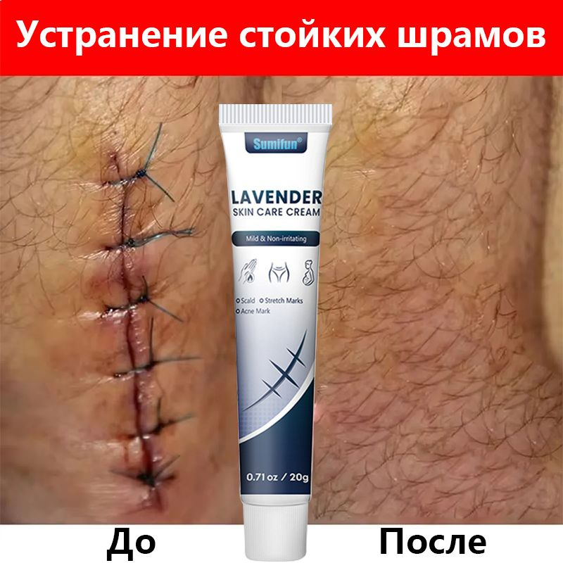 Крем для удаления шрамов 20 г устраняет шрамы уменьшает неровности ...