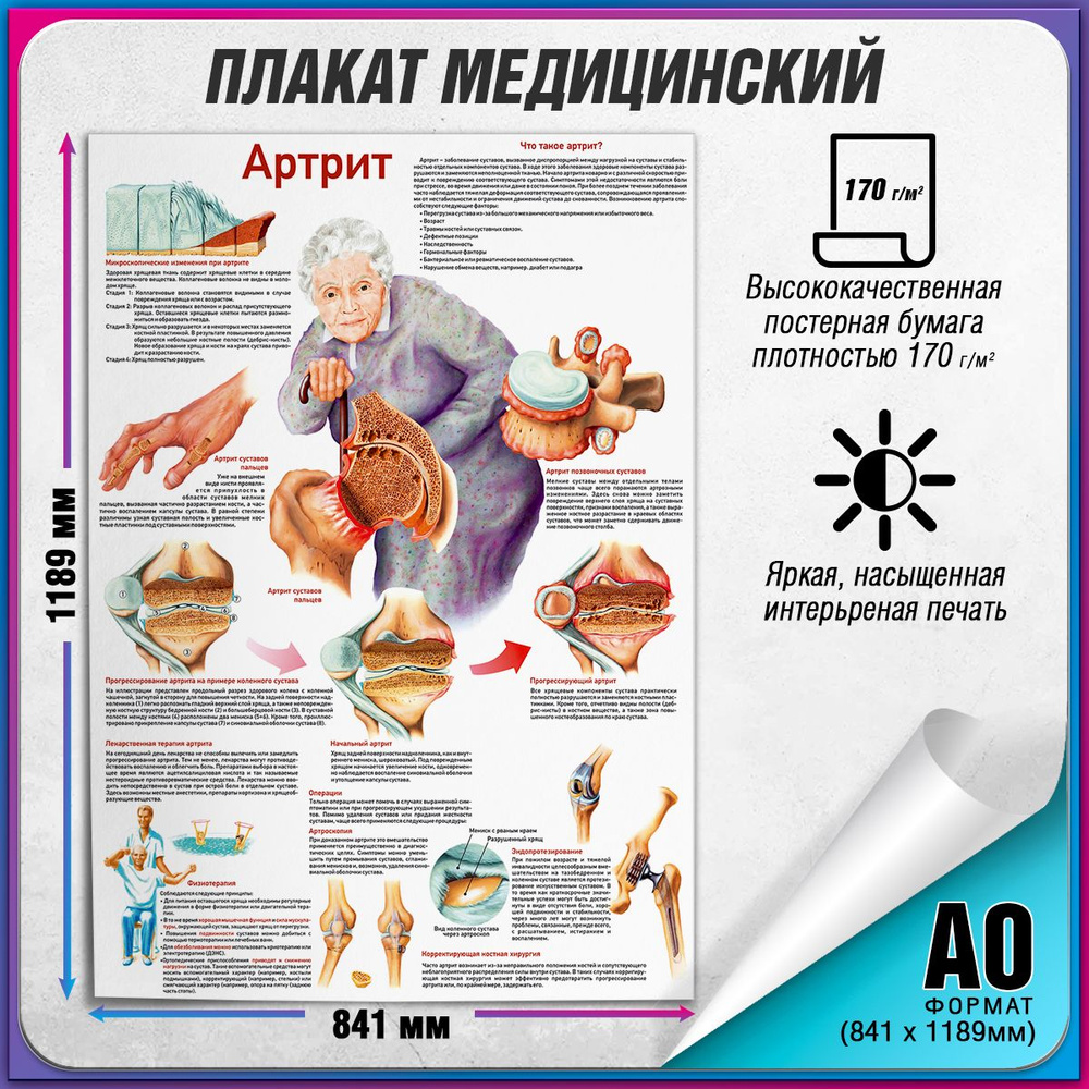 Информационный медицинский плакат "Артрит" / А-0 (119x84 см.)  #1