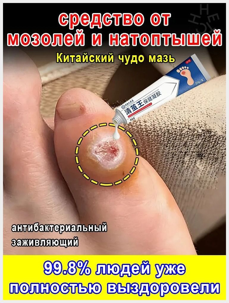 Пластырь от мозолей, стержневых натоптышей и бородавок 20 г Китайский чудо мазь #1