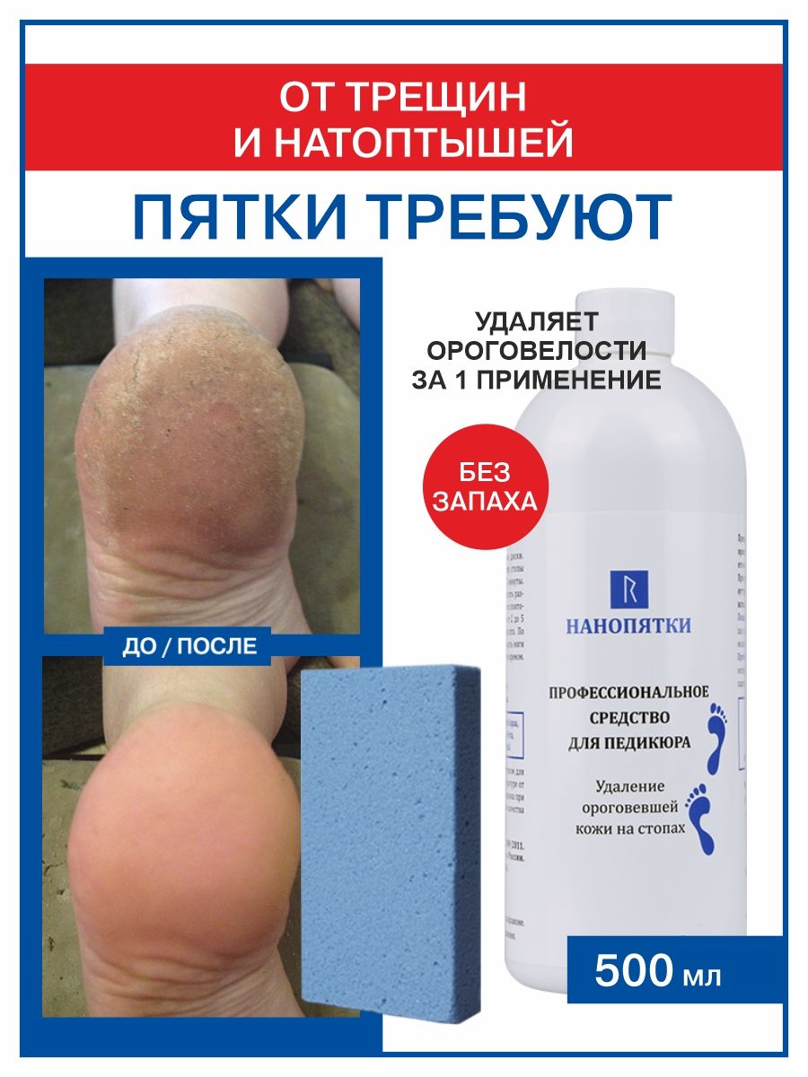 НАНОПЯТКИПрофессиональноесредстводляпедикюра,500мл+Пемзакосметическая,1штука.