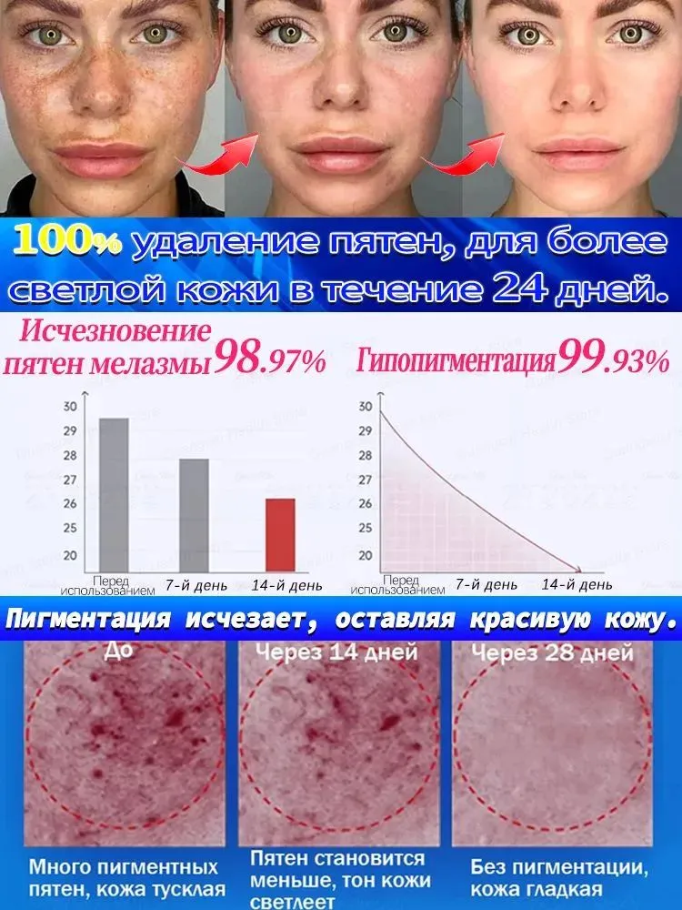 Удаляет пигментные пятна, веснушки, солнечные ожоги, меланодермию, угревую сыпь, морщины.Лазерная указка устраняет пигментацию на лице и теле и отбеливает кожу.1 палочка, вариант, фото 5