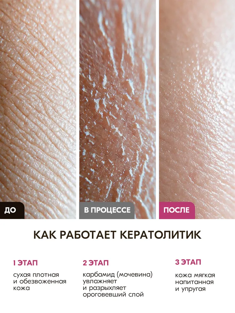Жидкий кератолитик средство для пяток от трещин и мозолей, вариант, фото 6