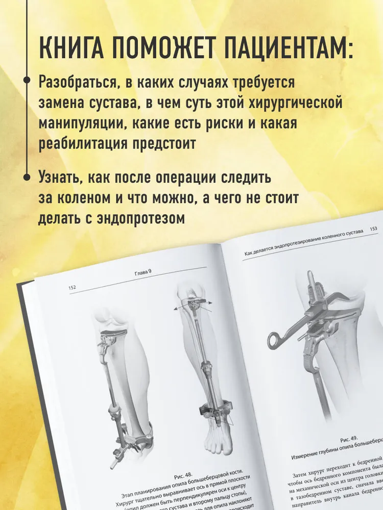Эндопротезирование коленного сустава: ответы практикующего врача на все вопросы пациентов, вариант, фото 3