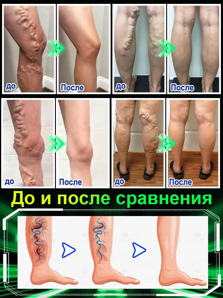 Лазерная ручка для лечения варикозного расширения вен Эффективно лечит варикозное расширение вен, снимает отечность, боль и усталость, улучшает кровообращение в ногах, безопасна и безболезненна. 1 шт., 1 шт, фото 3