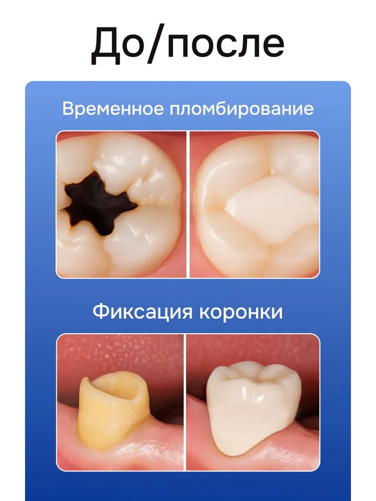 Временная пломба для зуба для взрослых / цемент для зубных коронок / зубной клей, вариант, фото 2