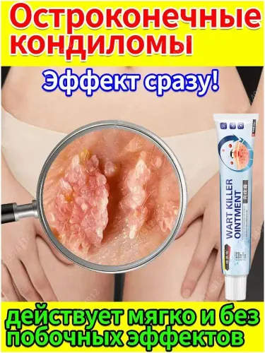 Эксклюзивный крем для устранения генитальных бородавок у женщин и мужчин. Лечение ВПЧ, папиллом в интимной зоне и на коже
