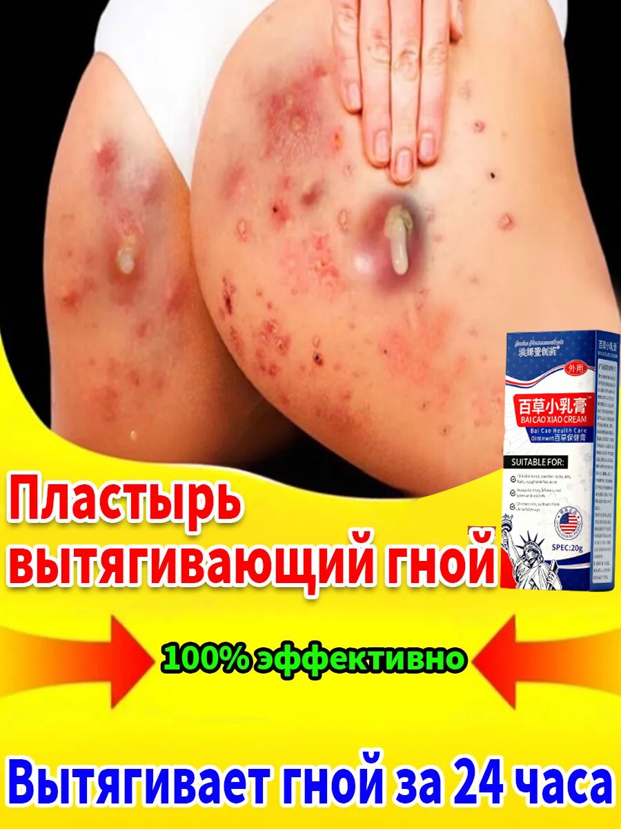 Вытягивающийотфурункулов,акнеигнойниковМазьотпрыщейнапопеКитайскаячудомазь20г