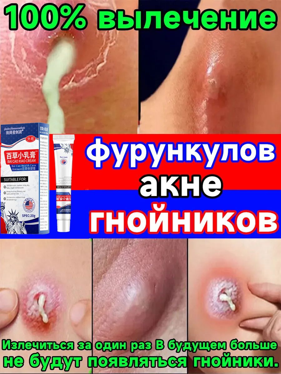 ВытягивающийМазьотфурункулов,акнеигнойников,КитайскаяЧУДОМАЗЬ.Быстрыйэффект.натуральныйсостав.20г