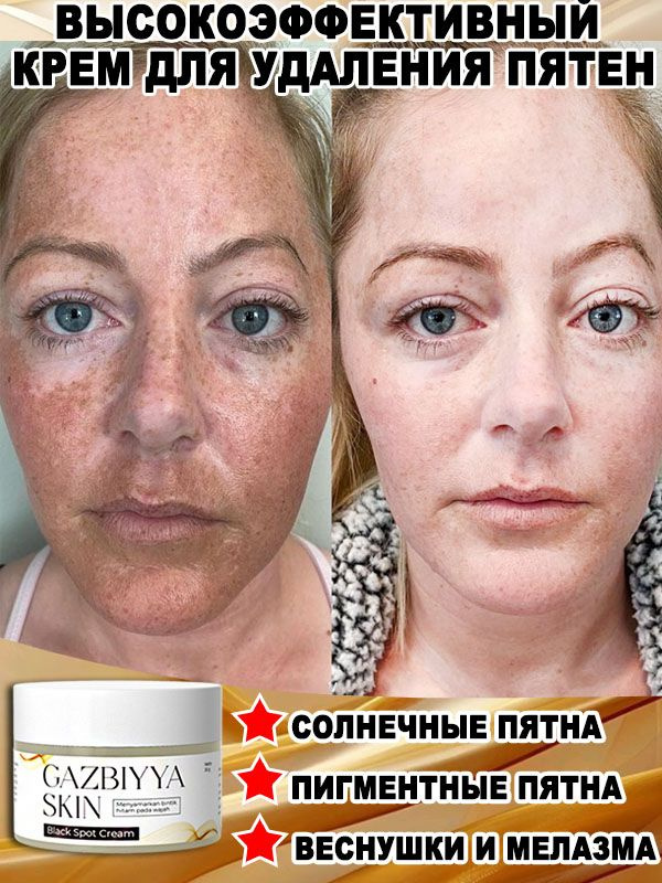 Отбеливающий крем от веснушек и солнечных пятен, подходит для удаления и исчезновения желтых пятен и #1