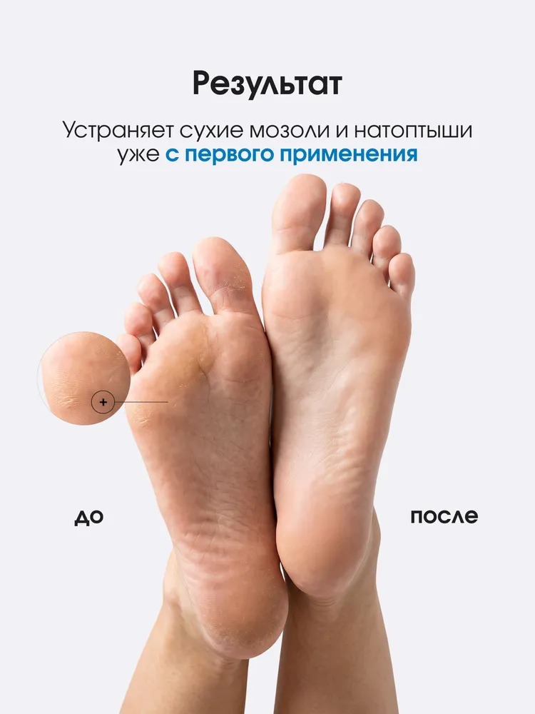 АКВАПИЛИНГ крем-паста от натоптышей и сухих мозолей с мочевиной 40%, 20 мл, 20 мл, фото 3