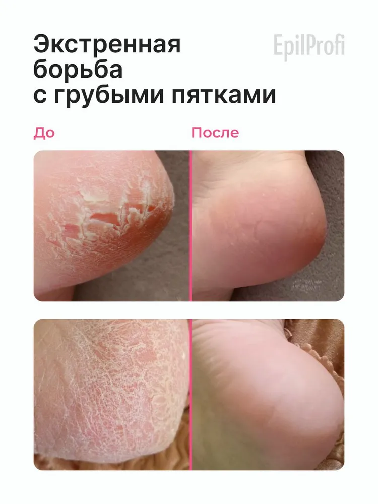 EpilProfi Кератолитик для пяток, кератолик жидкое лезвие от огрубевшей кожи, 2 пемзы для ног, 400 мл, 400 мл, фото 3