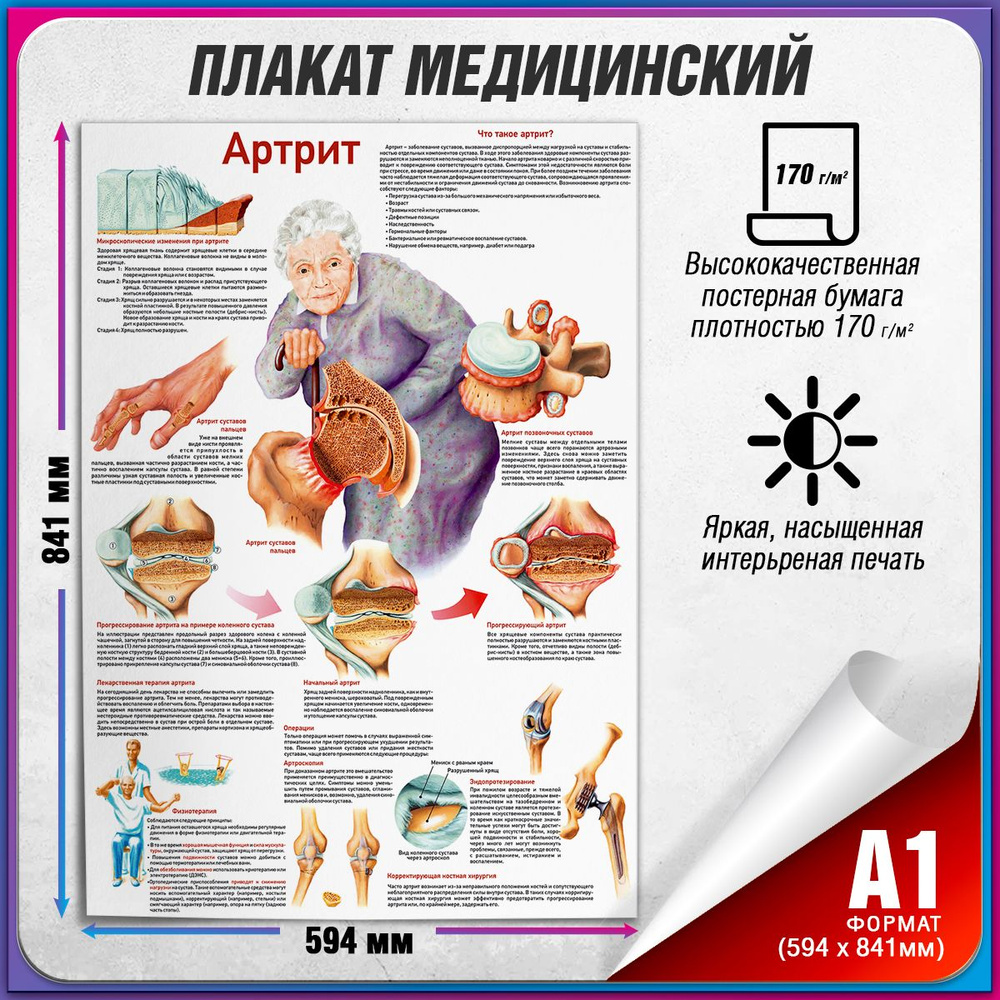 Информационный медицинский плакат "Артрит" / А-1 (84x60 см.) #1