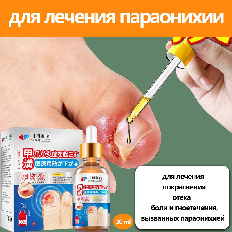 Медицинский гель для лечения вросших ногтей, снимающий боль, гнойные ...