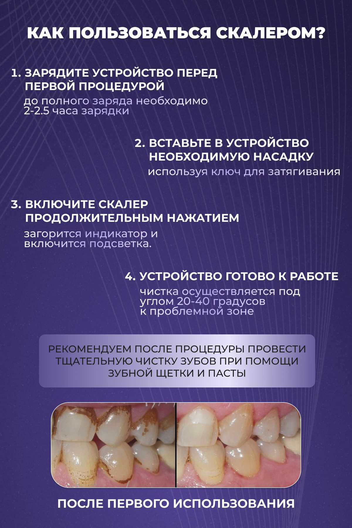 Ультразвуковой скалер для удаления зубного камня. Скалер для зубов от ...