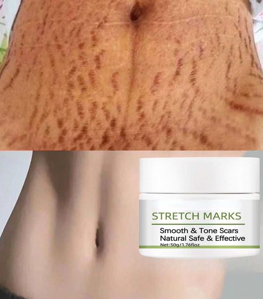 Как избавиться от растяжек и рубцов: народный рецепт с заговором