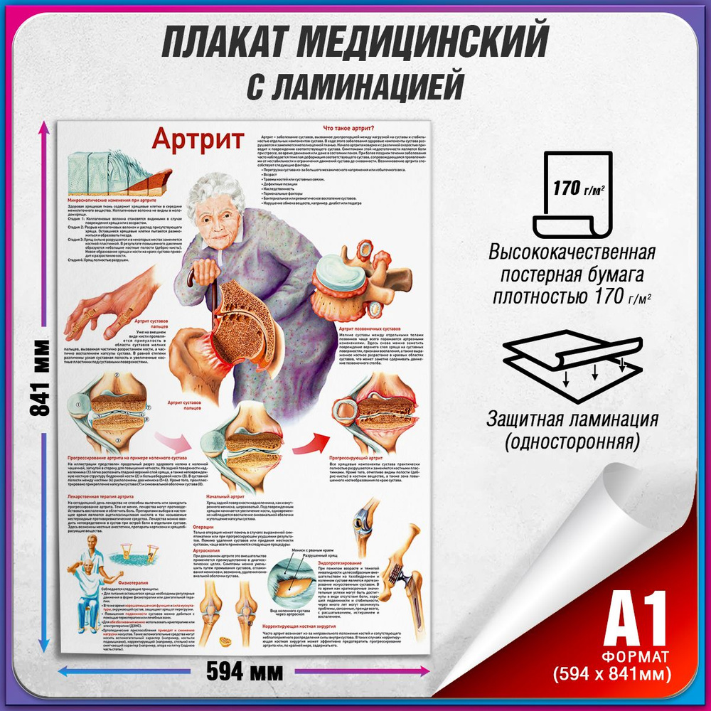 Информационный медицинский плакат "Артрит" / ламинированный / А-1 (84x60 см.)  #1