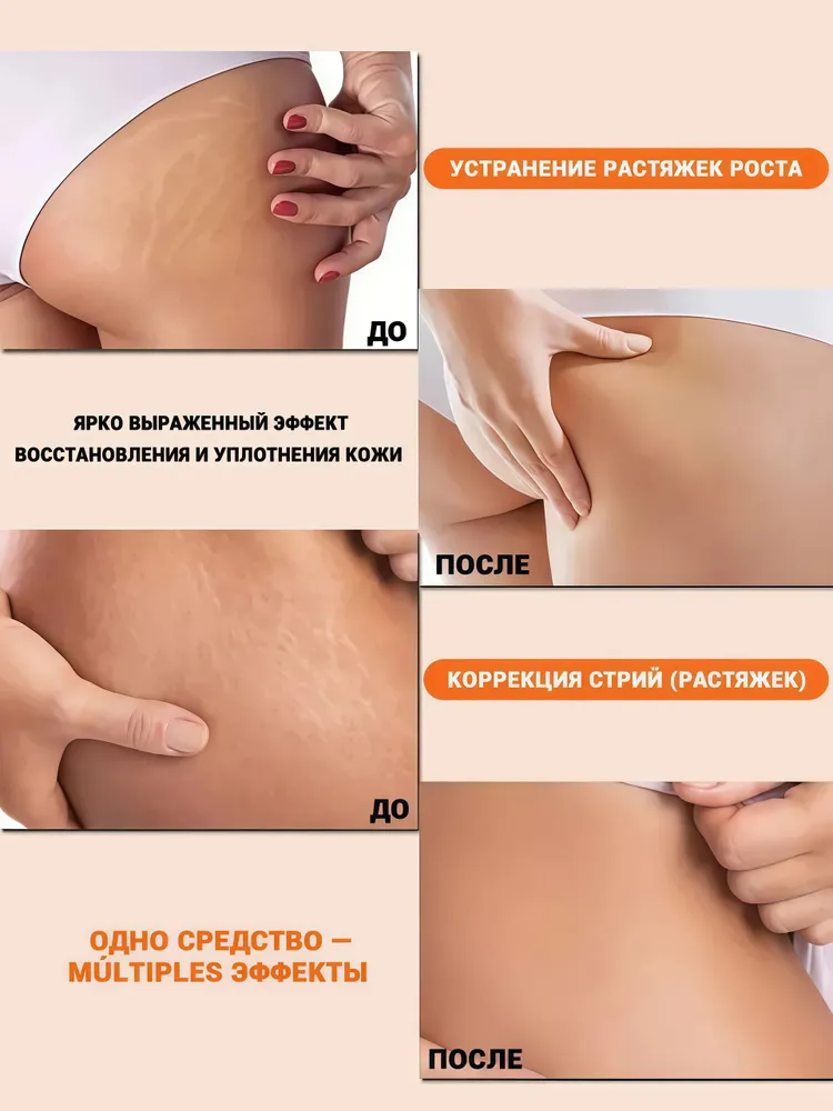 DR.SKINVITA Крем от растяжек для подростков 100 г, растяжек для беременных, подростков, для тела, крем косметическое от шрамов, 100 г, фото 6