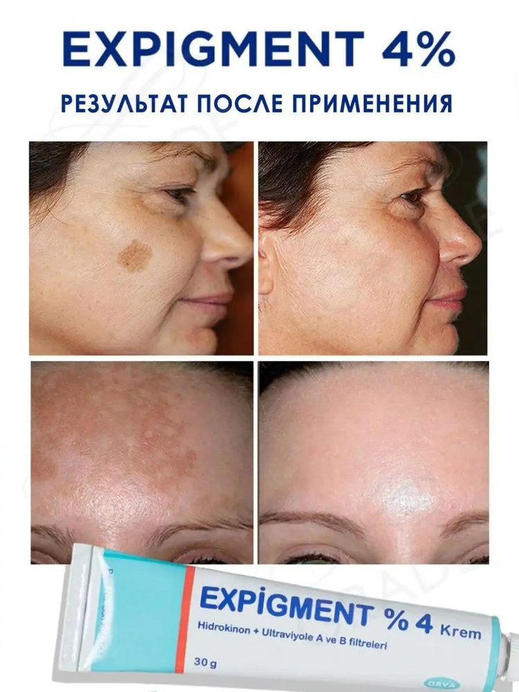 Expigment 4% Крем . Против темных и солнечных пятен на коже 30г ...