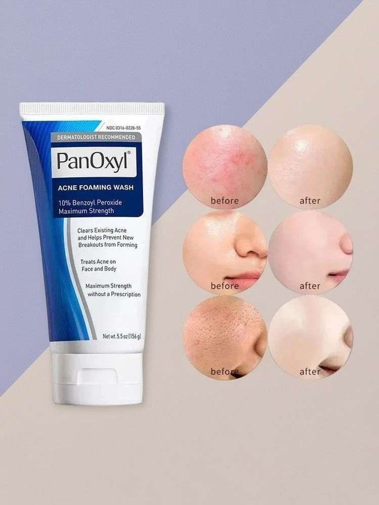 PanOxyl, Пенка для умывания от акне, перекись бензоила 10% максимальной концентрации, 156 г, от прыщей, #1
