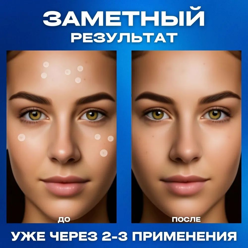 Пластырь от папиллом, патчи от прыщей, средство от бородавок, родинок и ...