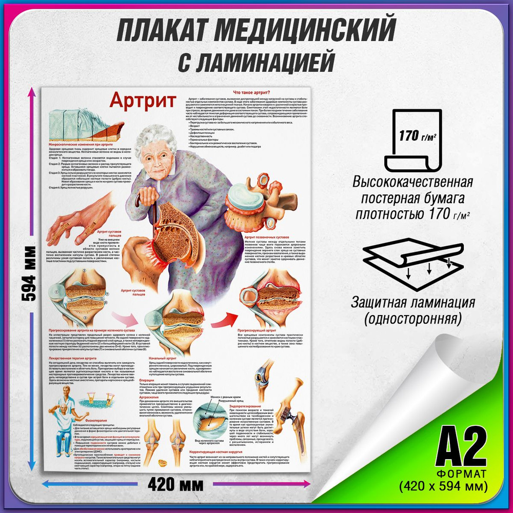 Информационный медицинский плакат "Артрит" / ламинированный / А-2 (60x42 см.)  #1