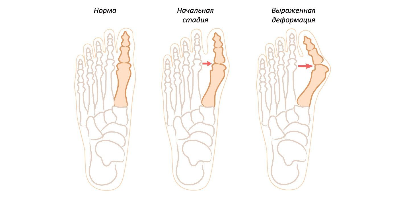 Вальгусная деформация