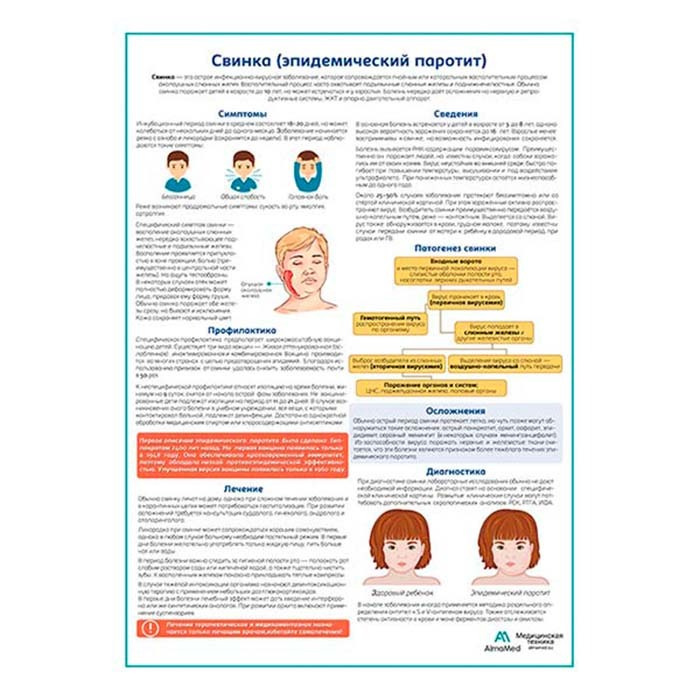 Свинка (эпидемический паротит) медицинский плакат A2+, плотная глянцевая фотобумага от 200г/м2  #1