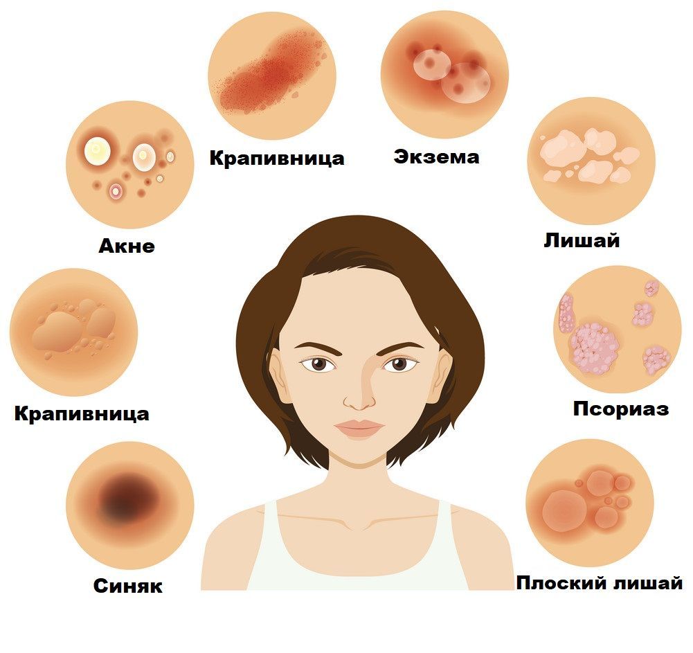 Крем мазь от псориаза из нафталанской нефти при кожных заболеваниях ...