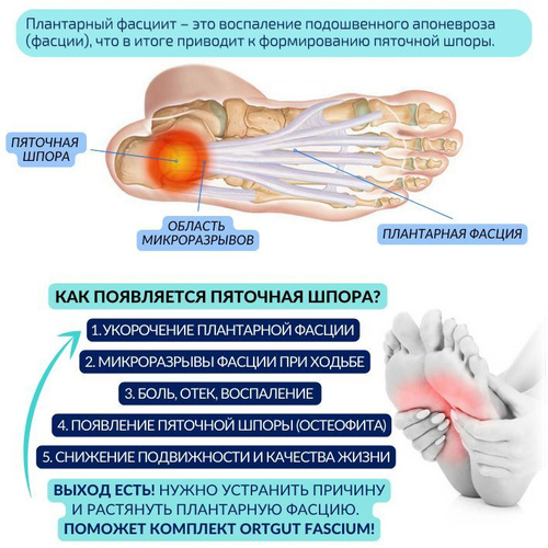 Упражнения, ортезирование и тейпирование при пяточной шпоре