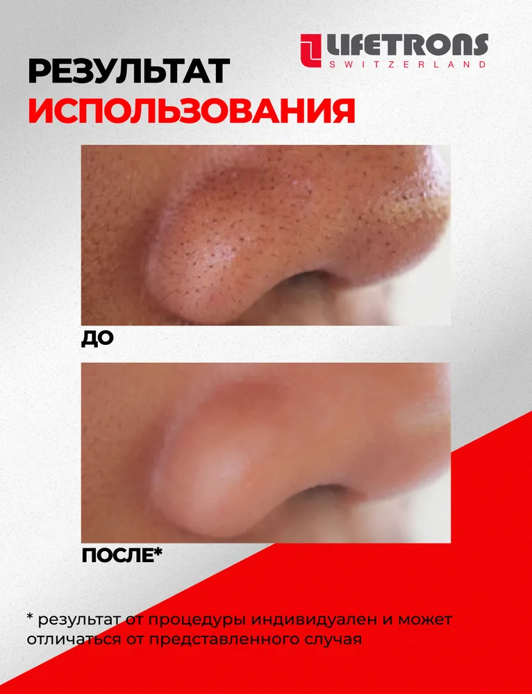 Ультразвуковая чистка лица, скрабер, EMS, микроток, аппарат от черных точек, Lifetrons, черный, фото 6