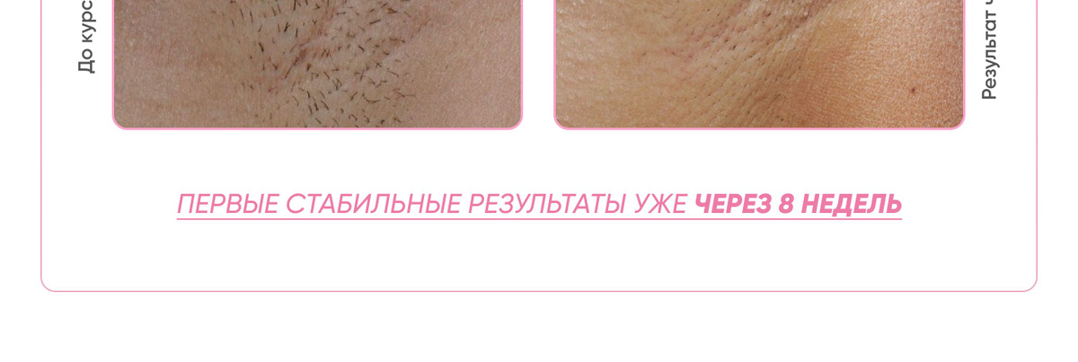 Домашний фотоэпилятор с функцией омоложения D'Evi Skin Pro купить на ...