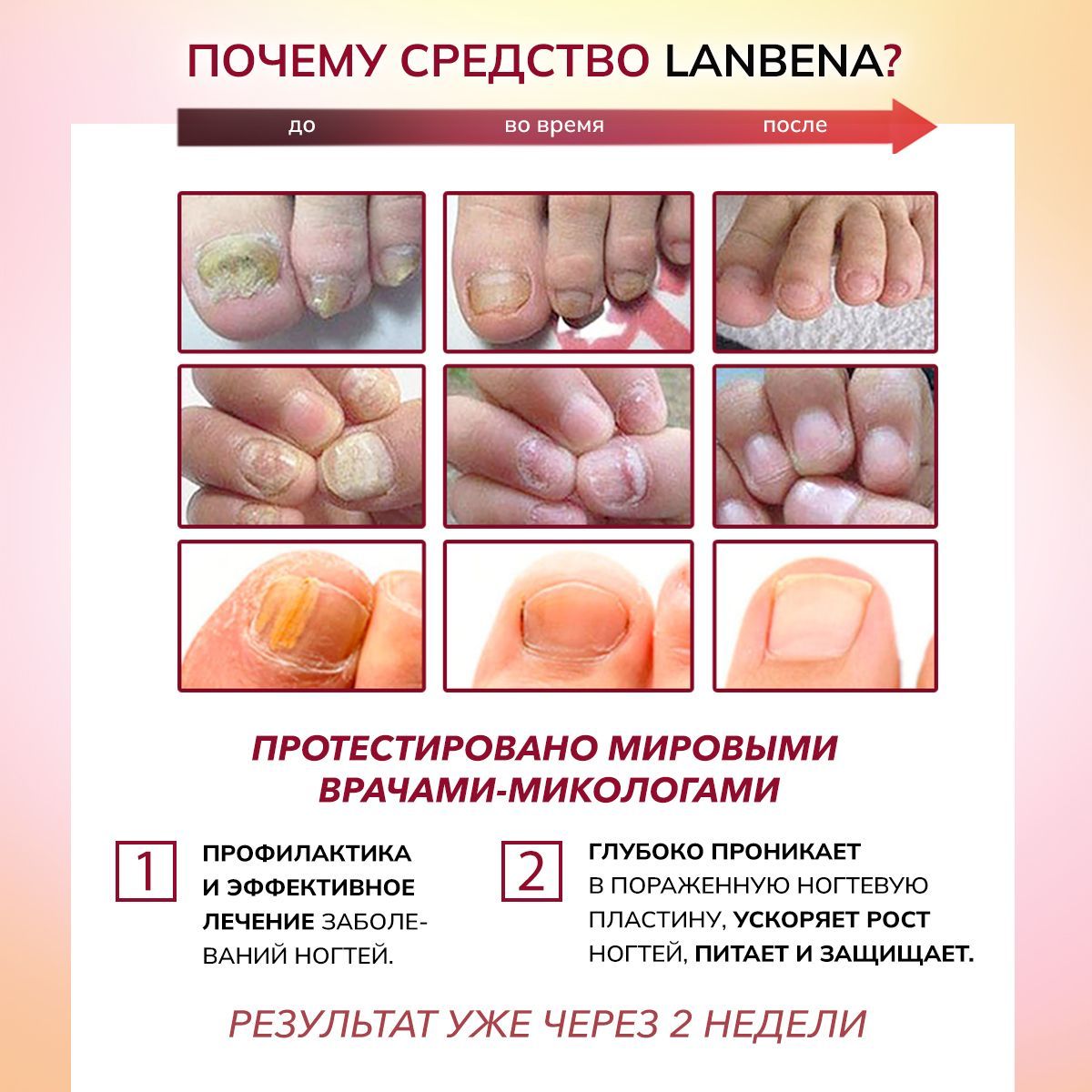 Средство для ногтей от грибка на ногах, бесцветный гель LANBENA / Уход ...