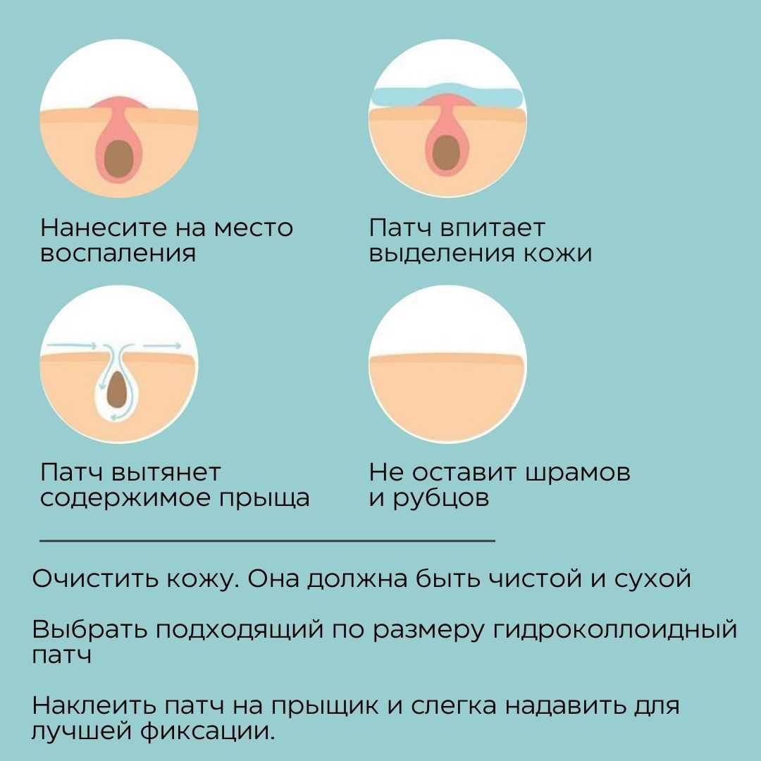 Патчи от прыщей на лице/Пластырь от прыщей - купить с доставкой по выгодным  ценам в интернет-магазине OZON (582260200)