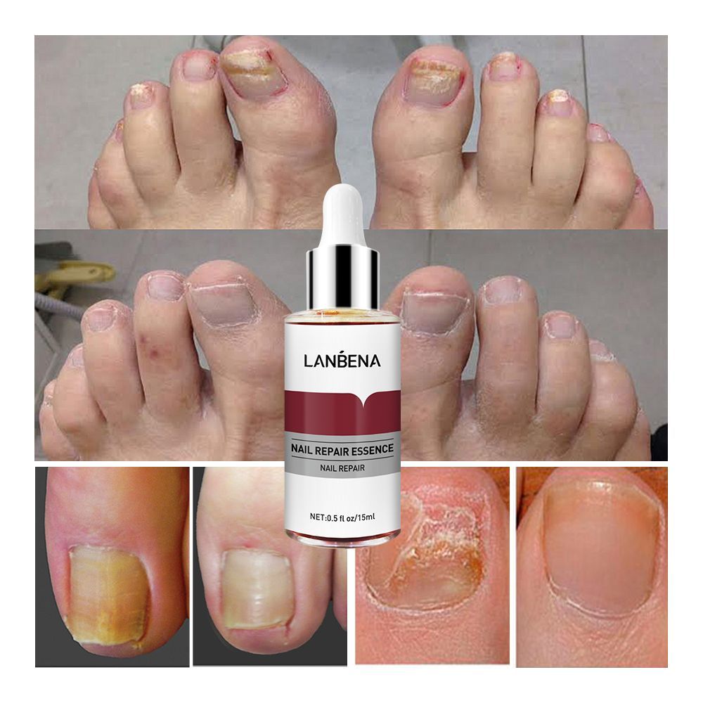 Ламбена. Средство от грибка ногтей LANBENA Nail Repair Essence 15 ml. Сыворотка эссенция LANBENA.