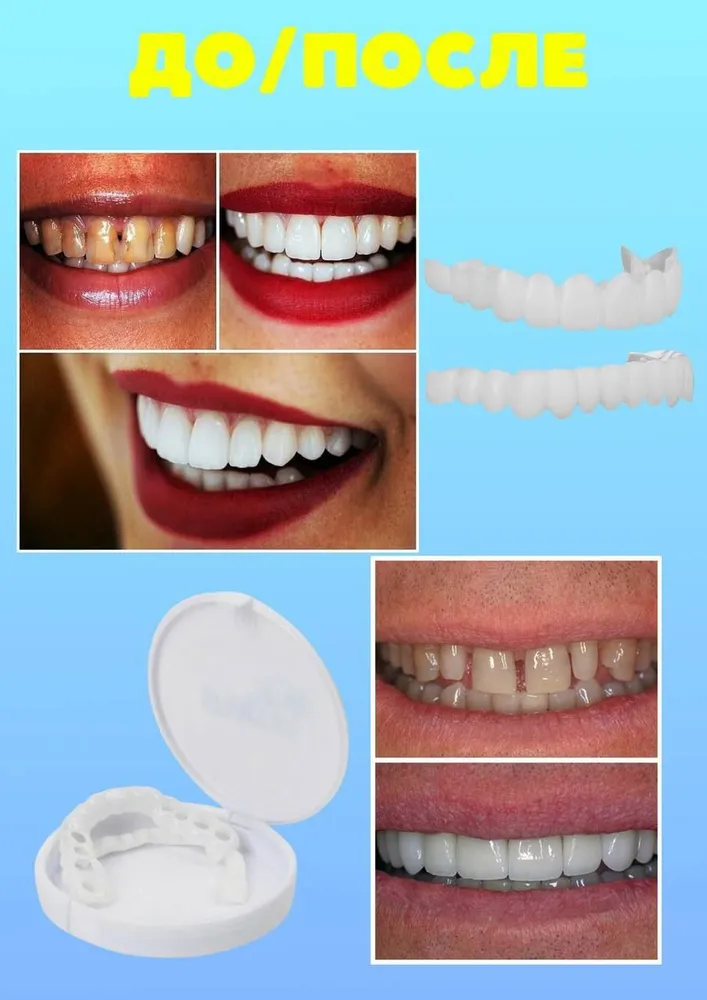 Виниры для зубов накладные верхние и нижние без десны Snapon Smile, вариант, фото 4