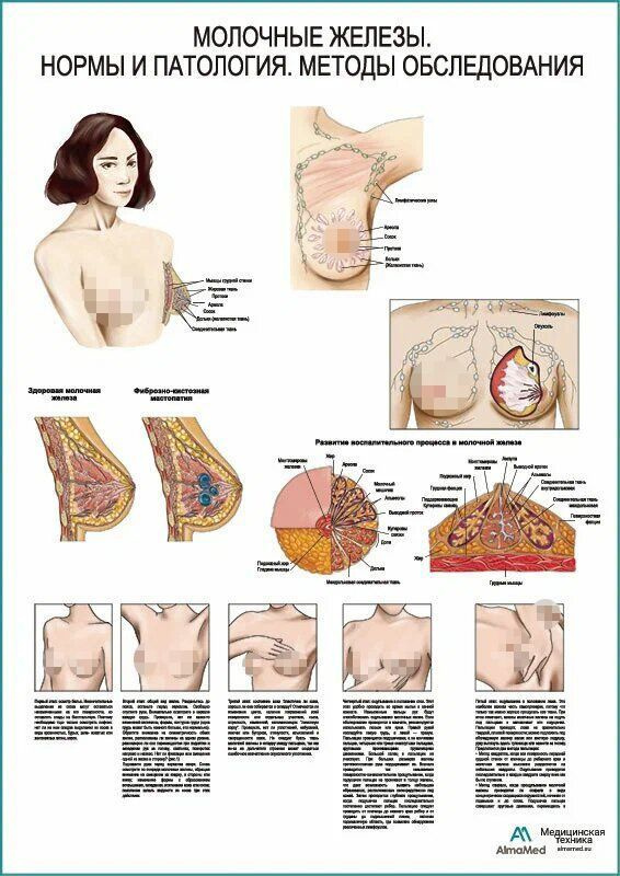 Молочные железы, мастопатия, самообследование (анатомия человека) плакат глянцевый А1+, глянцевый холст #1