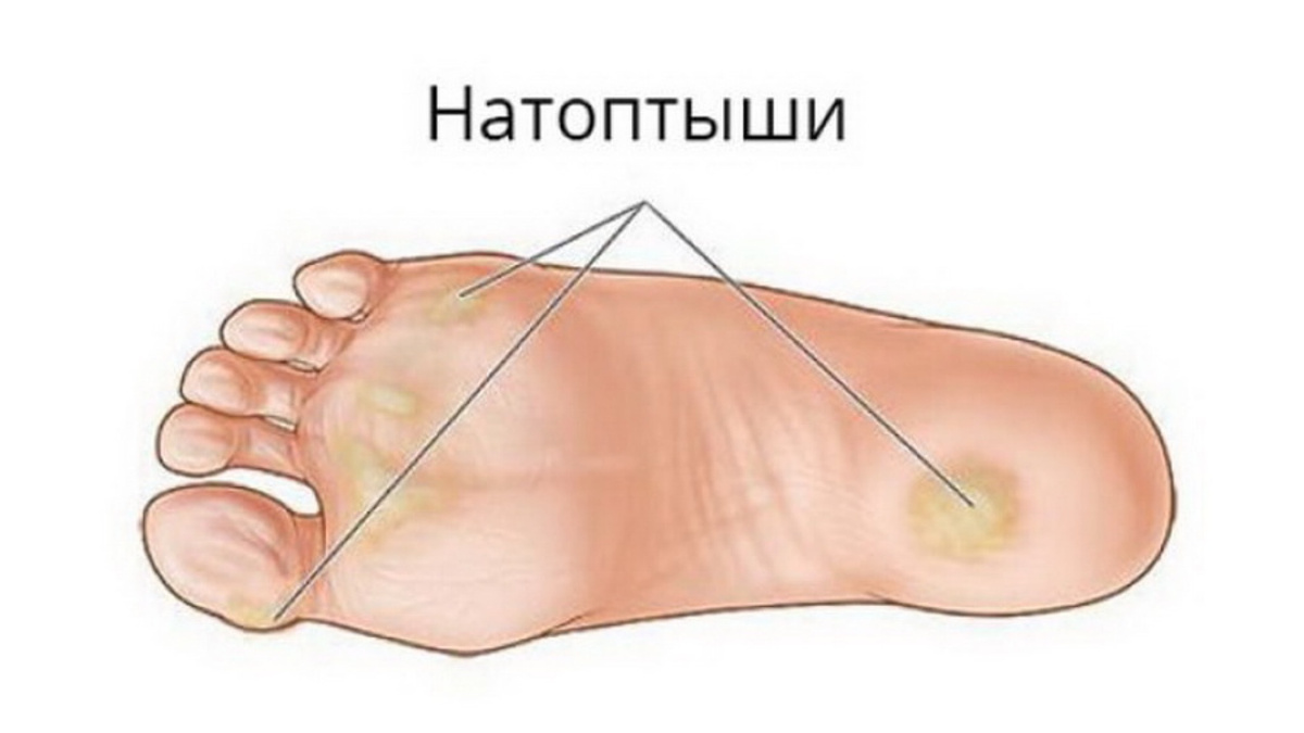 Ointments from dry calluses: improvised inexpensive means. Dry calluses are coar