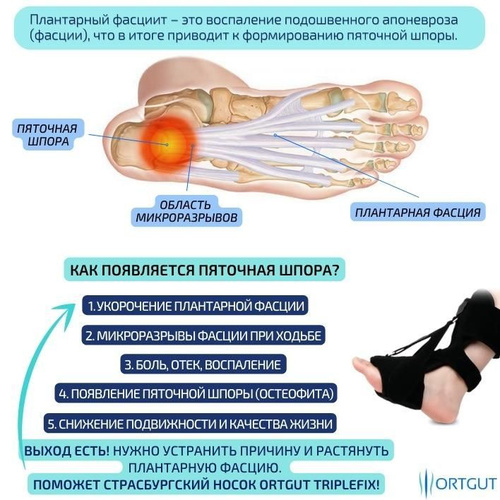 Пяточная шпора левой, правой ноги, боль при наступании, что это, как лечить.